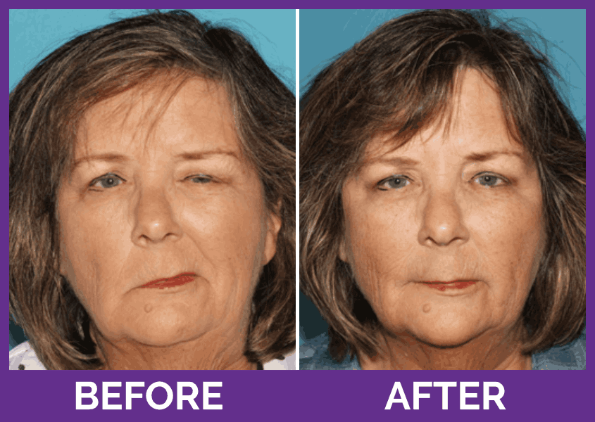 Botox; it’s not just for cosmetics! Houston