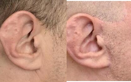 Male facelift ear comparison illustrating pre-tragal incision placement and the natural beard line