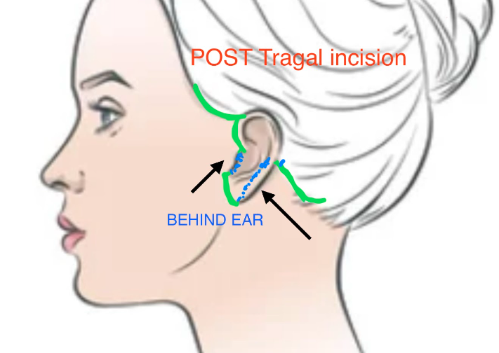 Diagram showing a post-tragal facelift incision behind the tragus
