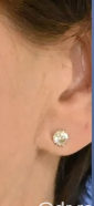 Close-up of post-tragal incision placement at the left ear