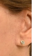Close-up of post-tragal incision placement at the right ear