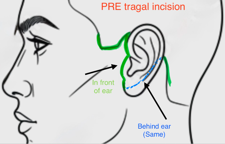 Diagram showing a pre-tragal facelift incision in front of the ear
