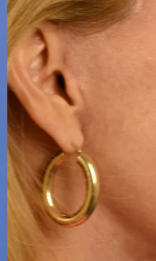 Close-up of pre-tragal incision placement at the right ear