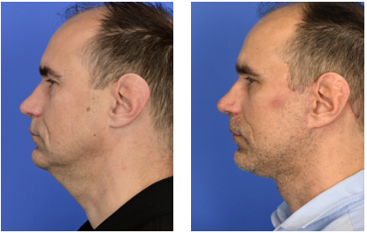 Male facelift before and after with natural masculine results