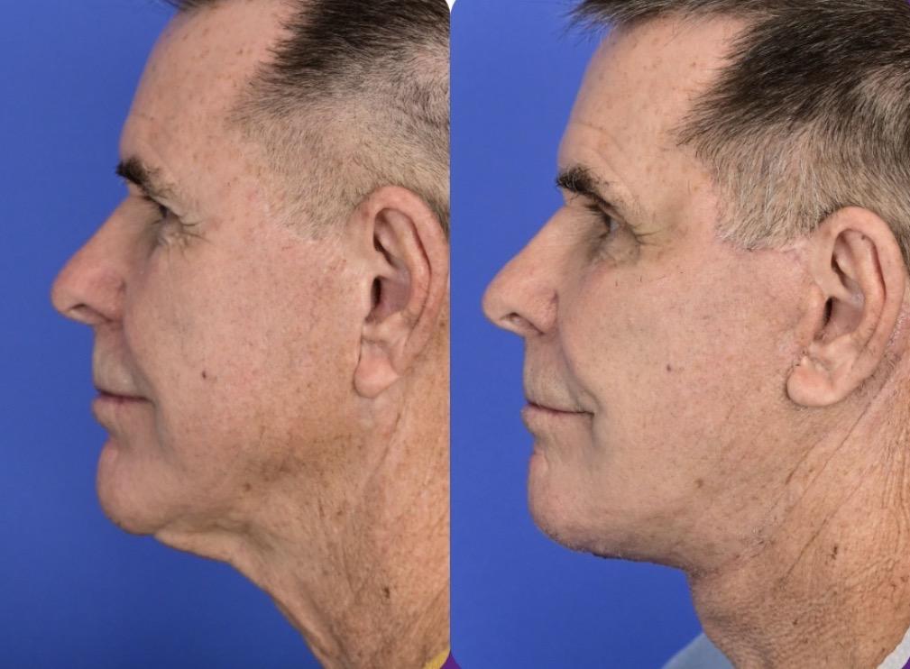 Male facelift before and after showing improved neck and jawline definition