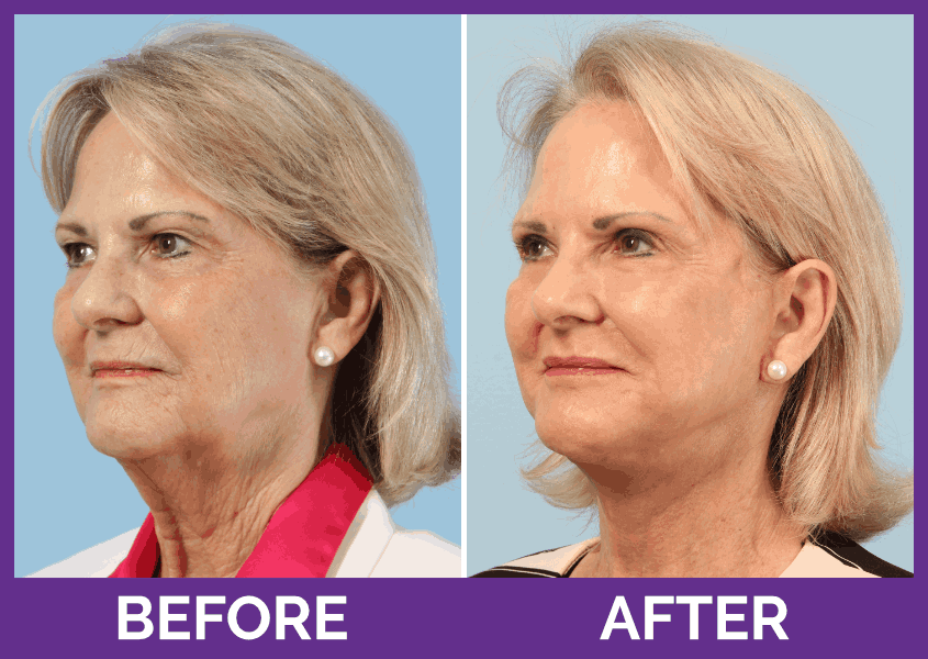 Renuvion Skin Tightening 