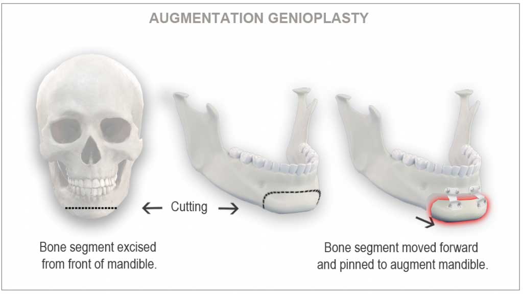 Osseous Genioplasty Houston 