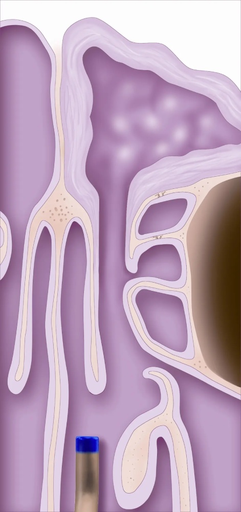 Balloon Sinuplasty Houston 