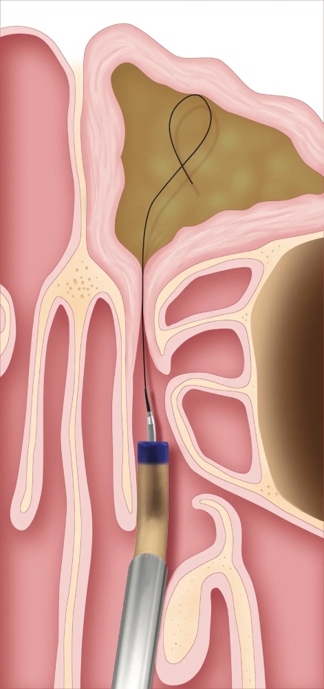 Balloon Sinuplasty Houston 