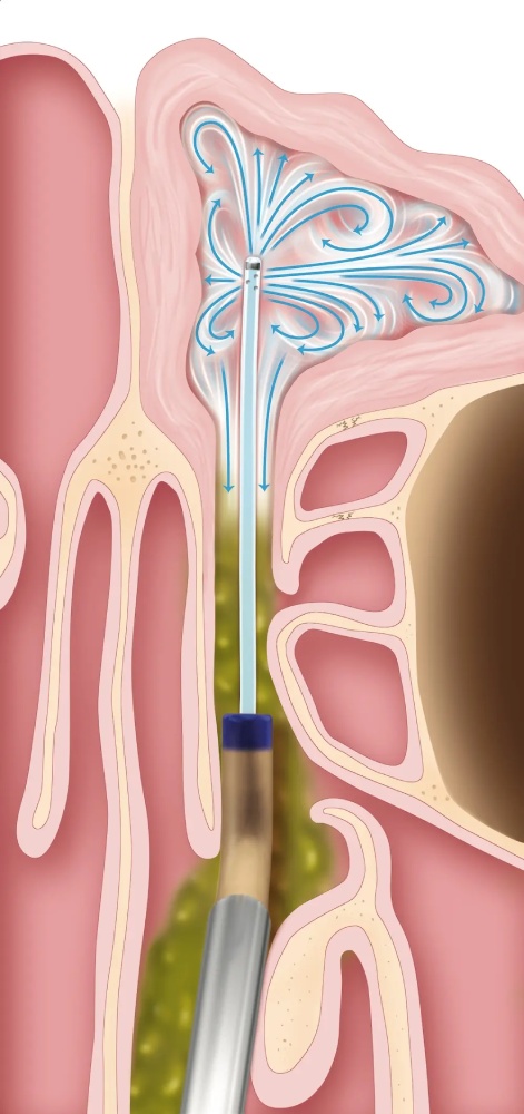 Balloon Sinuplasty Houston 