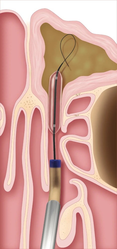 Balloon Sinuplasty Houston 