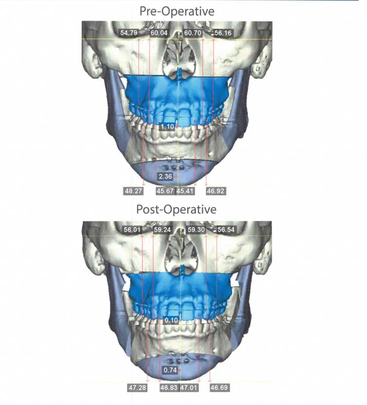 Orthognathic Surgery – Rodman, Regina (faceforwardhouston.com) Houston