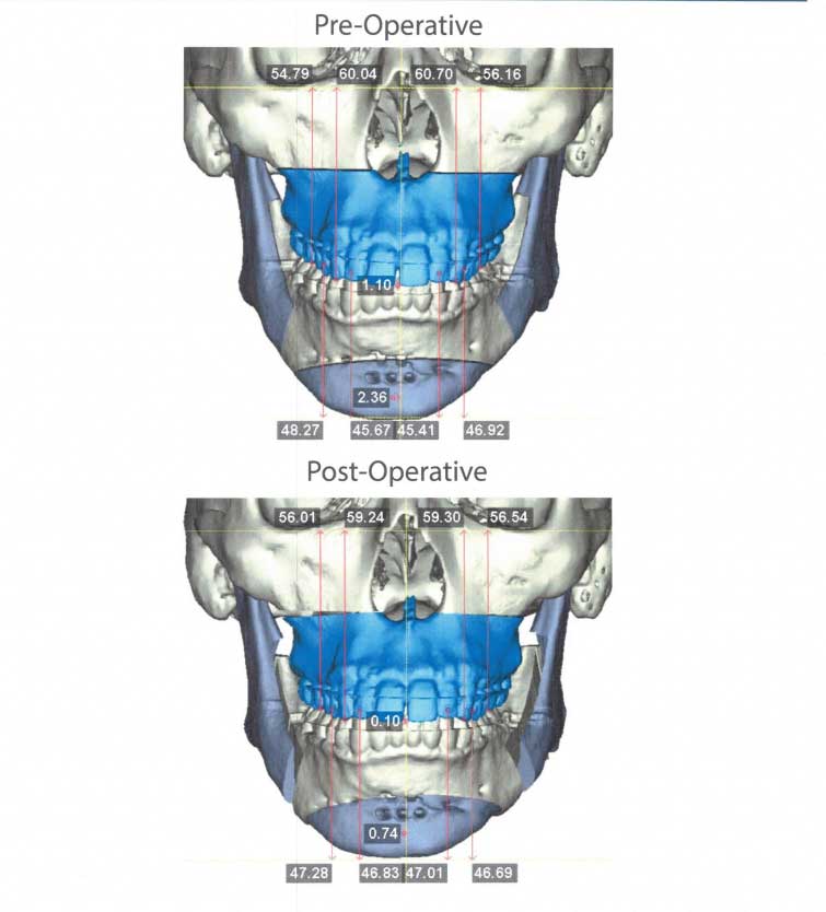 Orthognathic Surgery Houston 