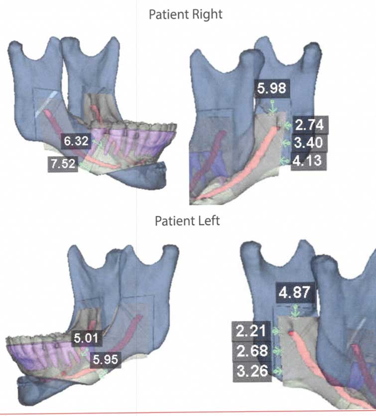 Orthognathic Surgery Houston 