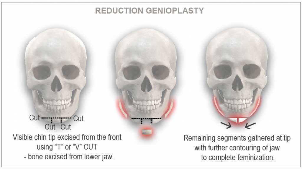 Osseous Genioplasty Houston 