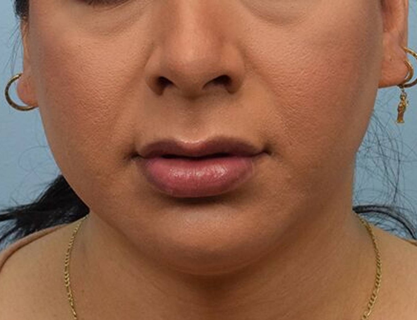 Buccal Fat Removal Before & After Image