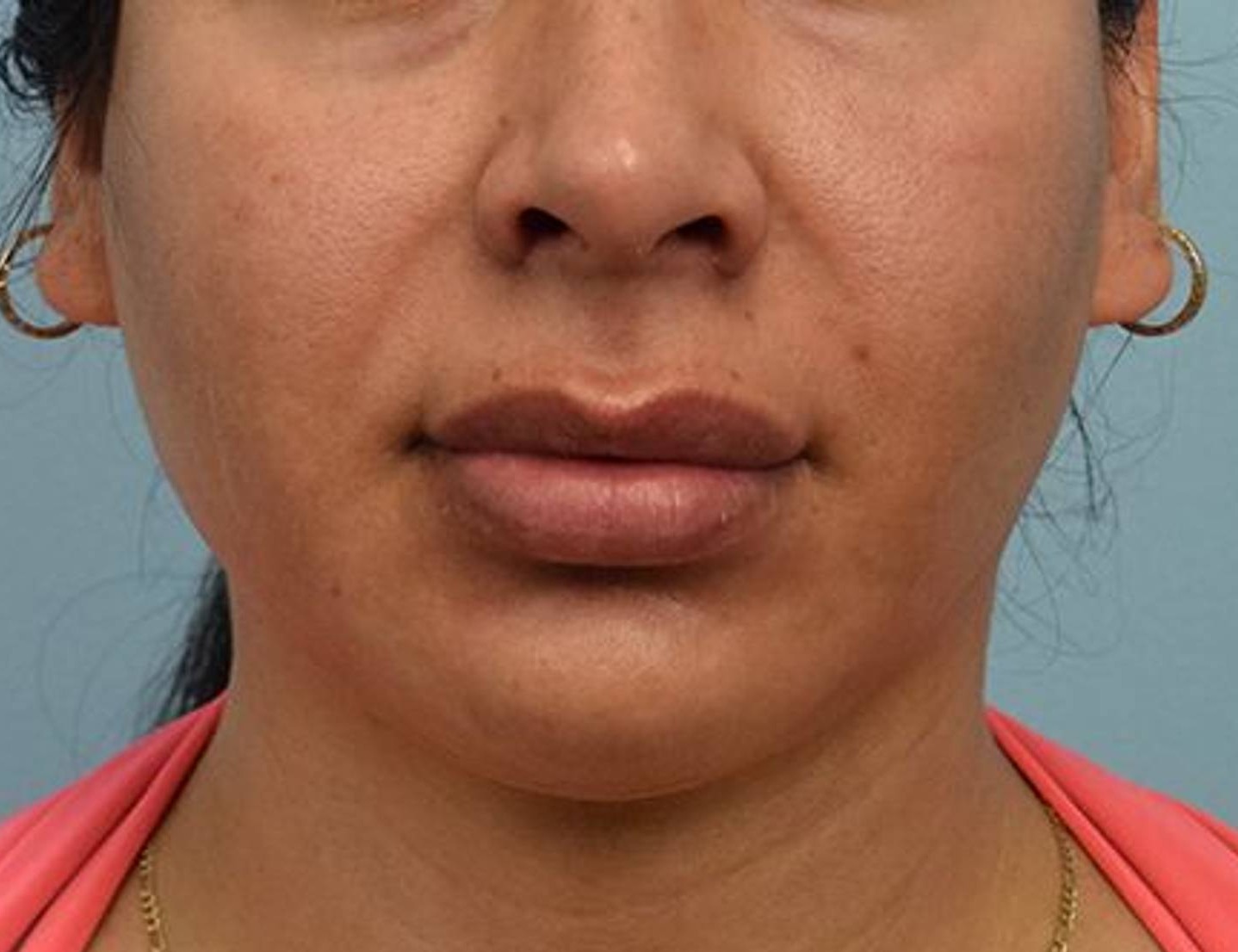 Buccal Fat Removal Before & After Image