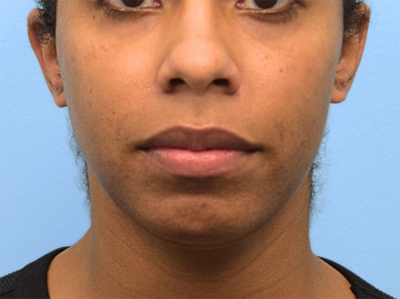 Buccal Fat Removal Before & After Image