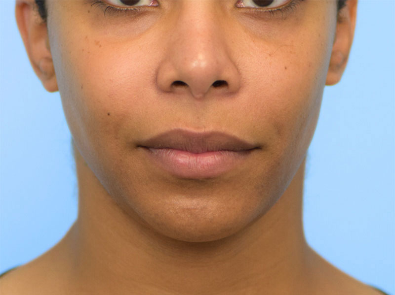 Buccal Fat Removal Before & After Image