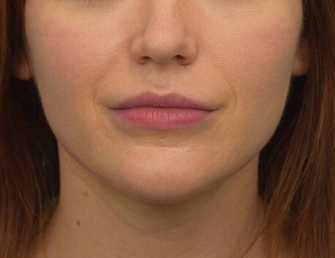 Buccal Fat Removal Before & After Image