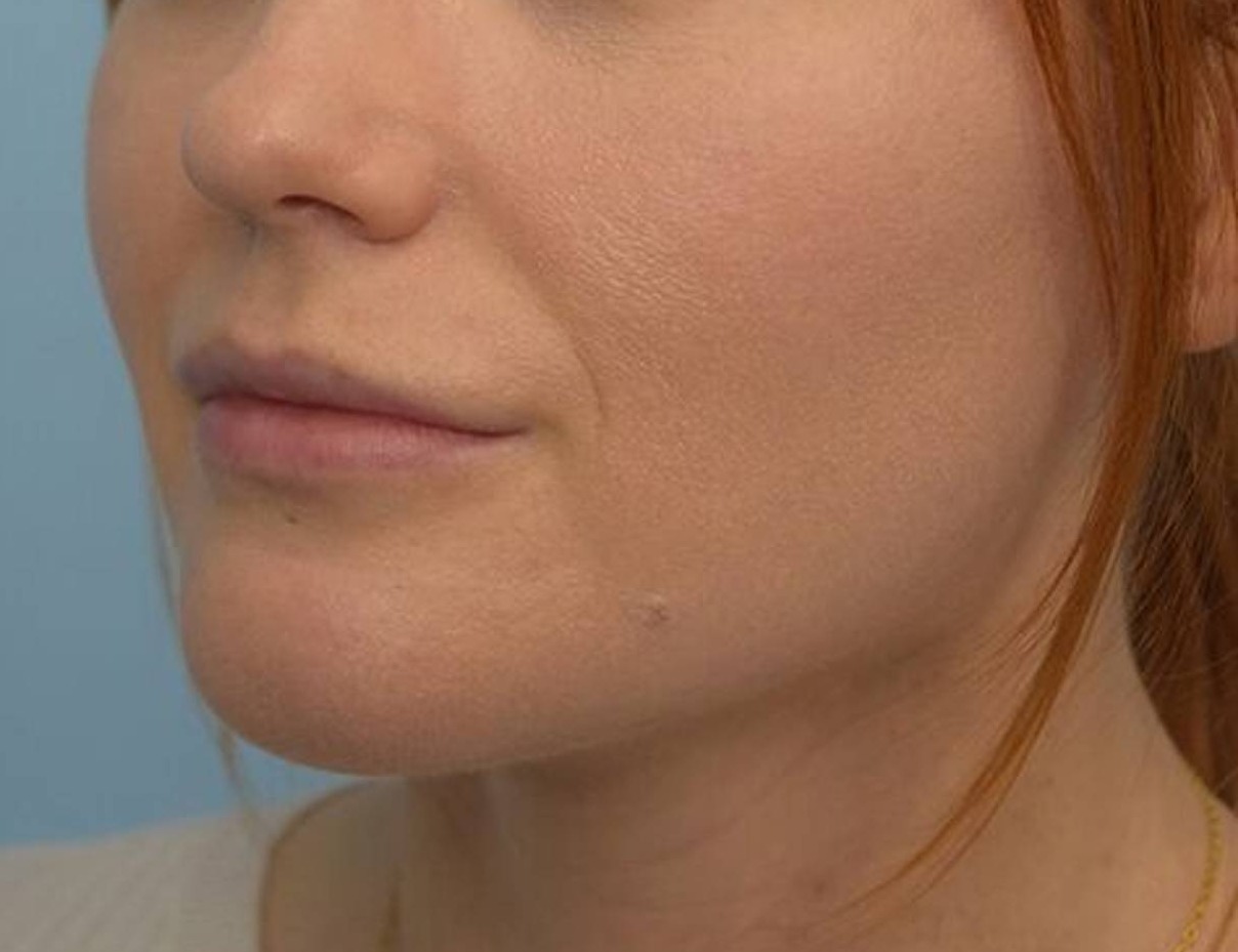 Buccal Fat Removal Before & After Image