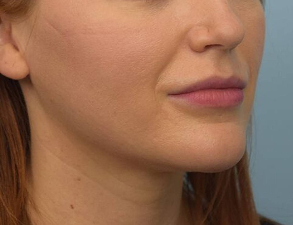 Buccal Fat Removal Before & After Image