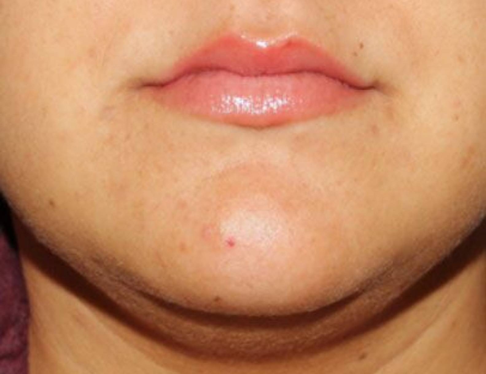 Buccal Fat Removal Before & After Image