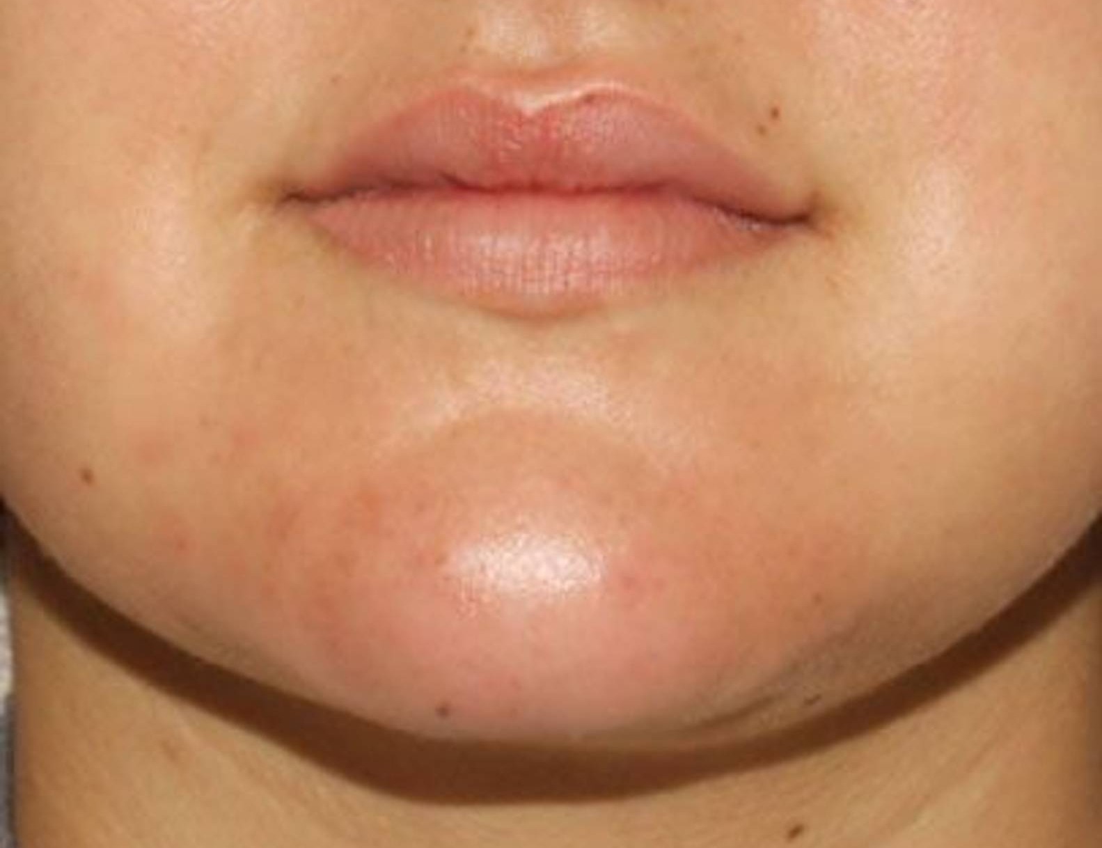 Buccal Fat Removal Before & After Image