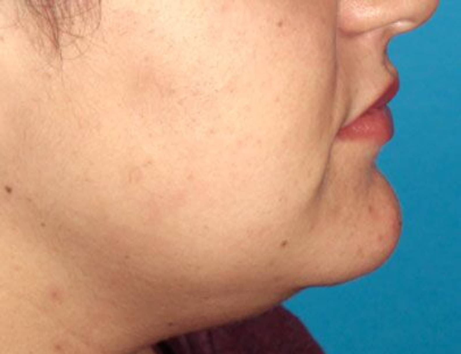 Buccal Fat Removal Before & After Image