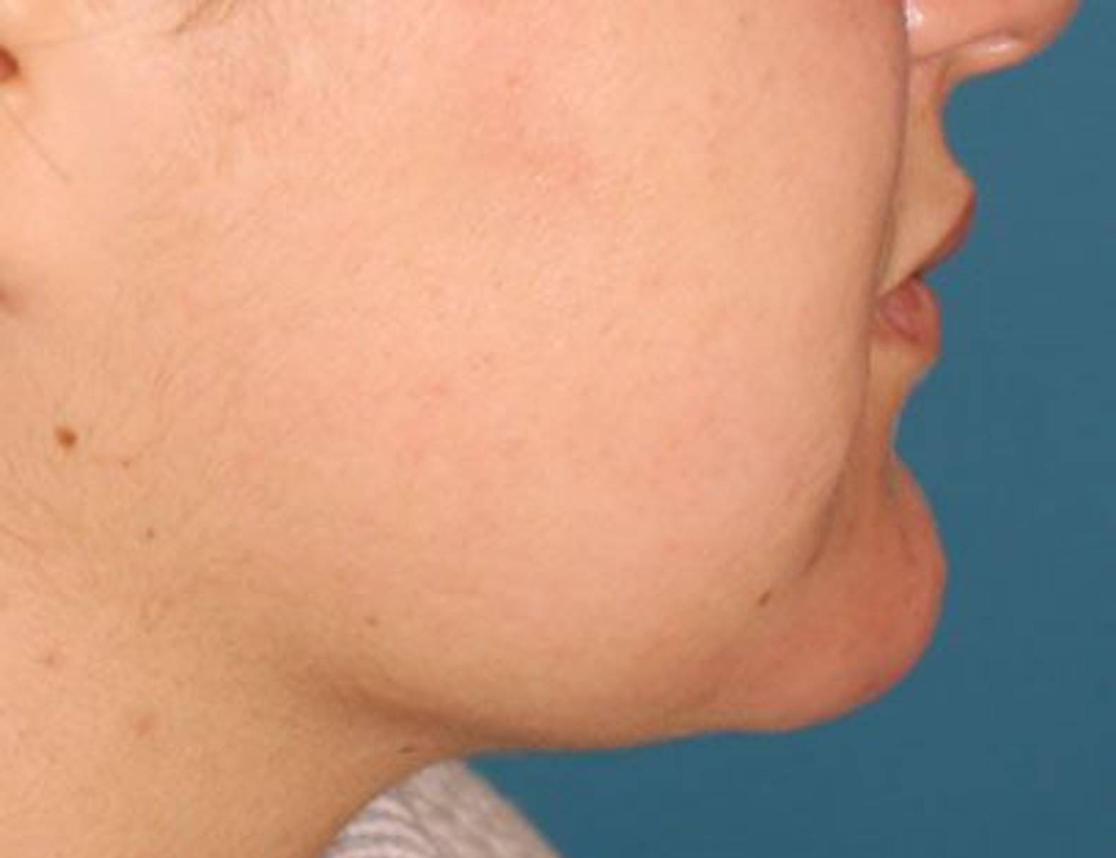 Buccal Fat Removal Before & After Image