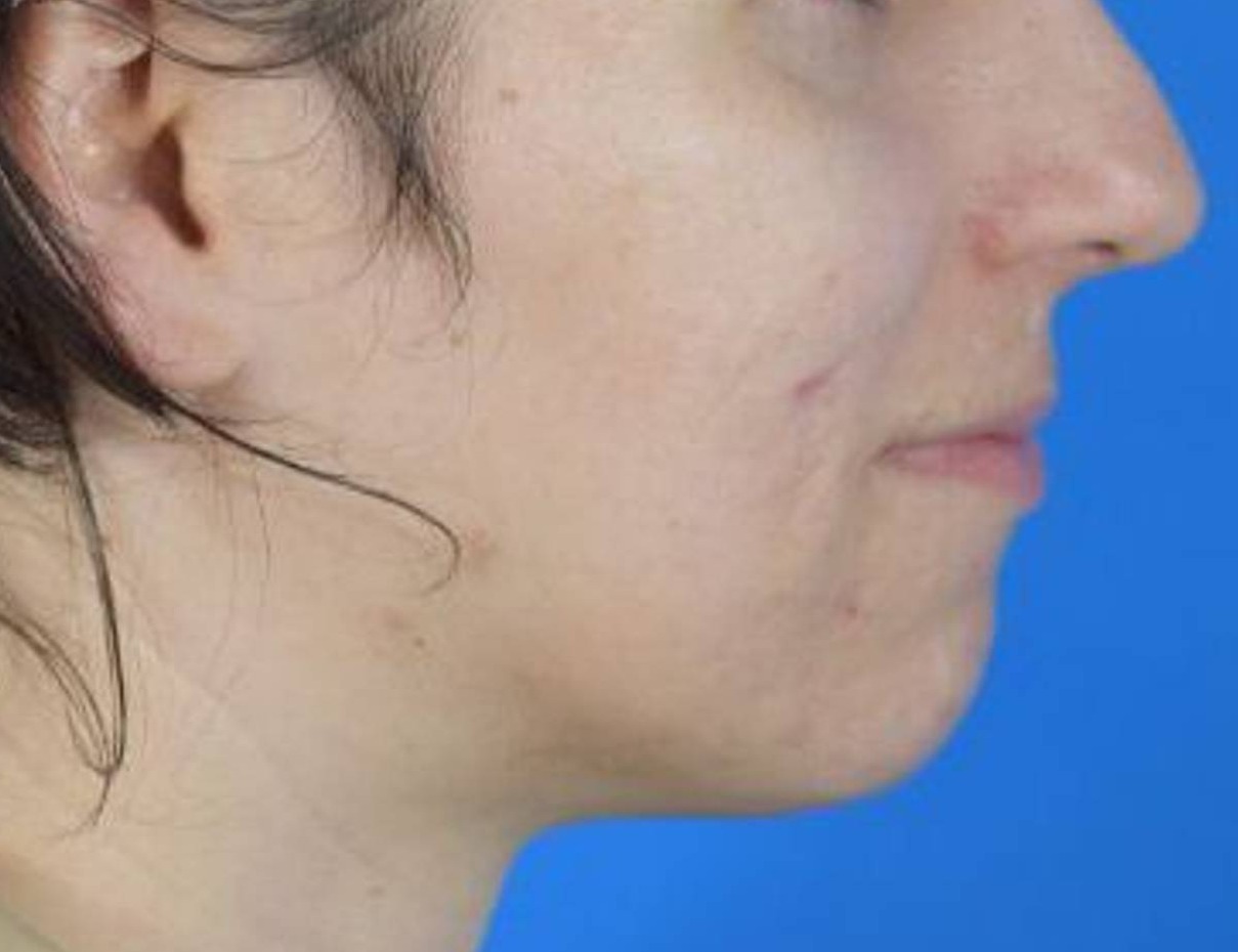 Buccal Fat Removal Before & After Image