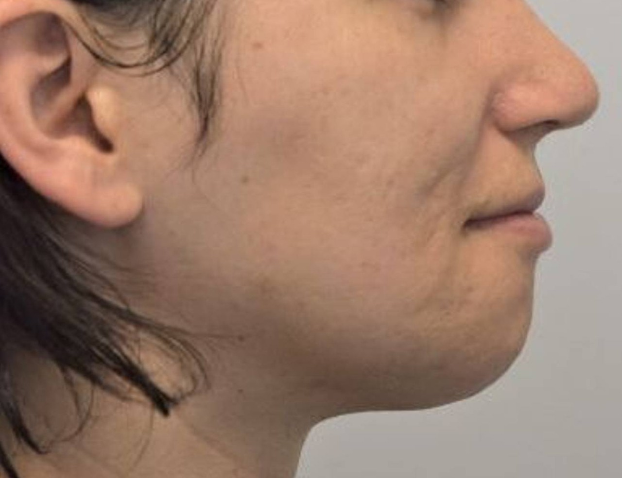 Buccal Fat Removal Before & After Image