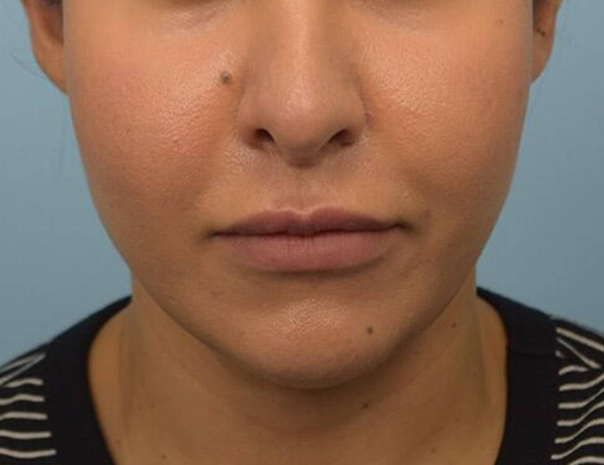 Buccal Fat Removal Before & After Image