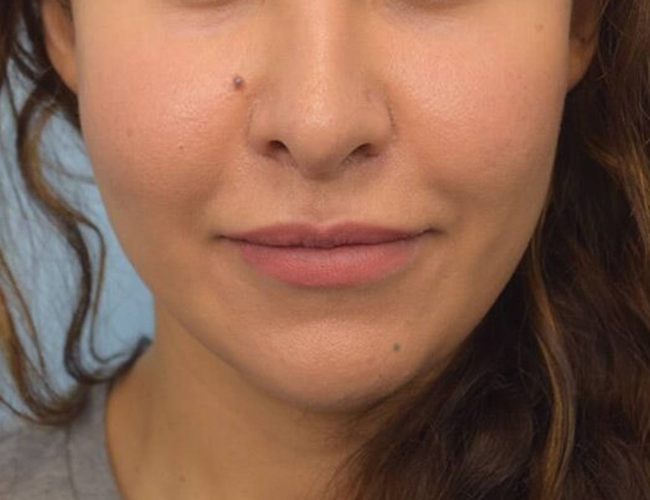 Buccal Fat Removal Before & After Image