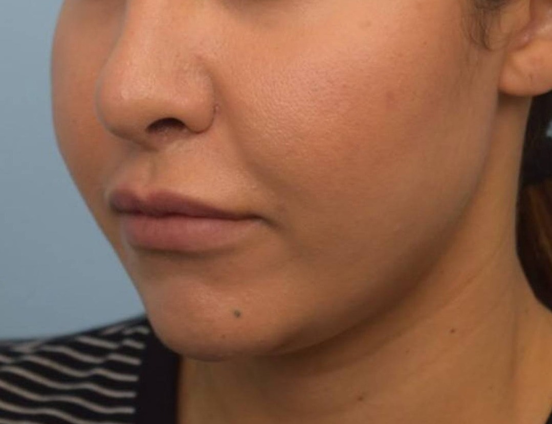 Buccal Fat Removal Before & After Image