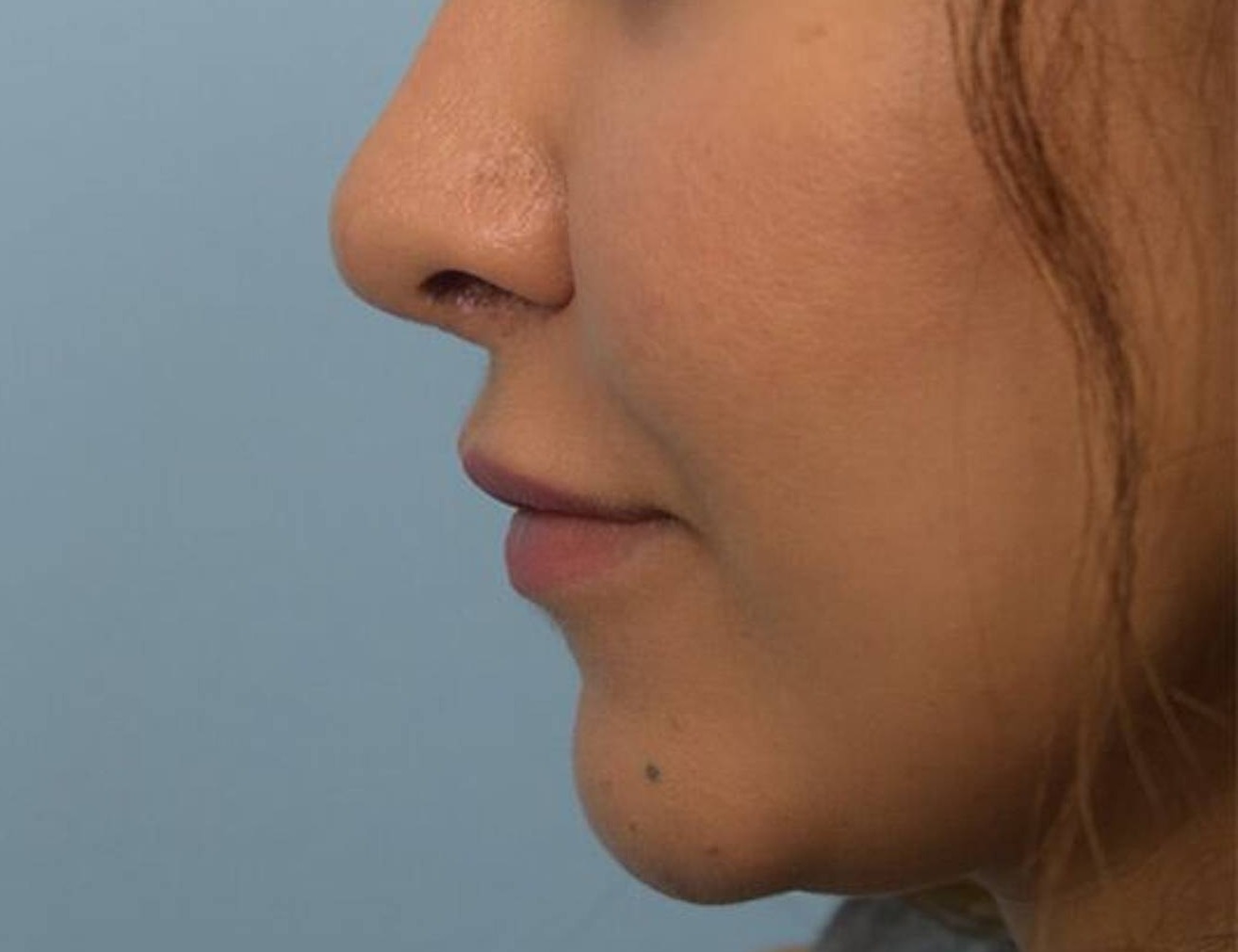 Buccal Fat Removal Before & After Image