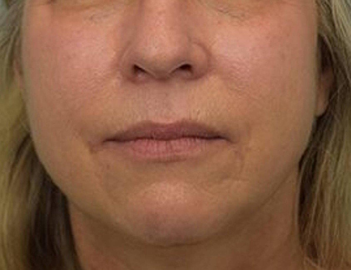 Buccal Fat Removal Before & After Image