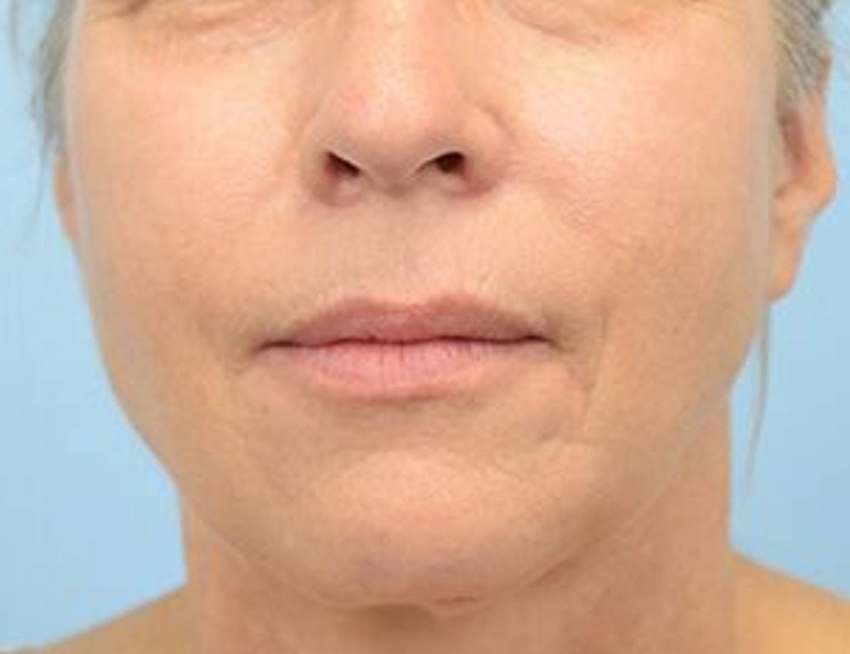 Buccal Fat Removal Before & After Image