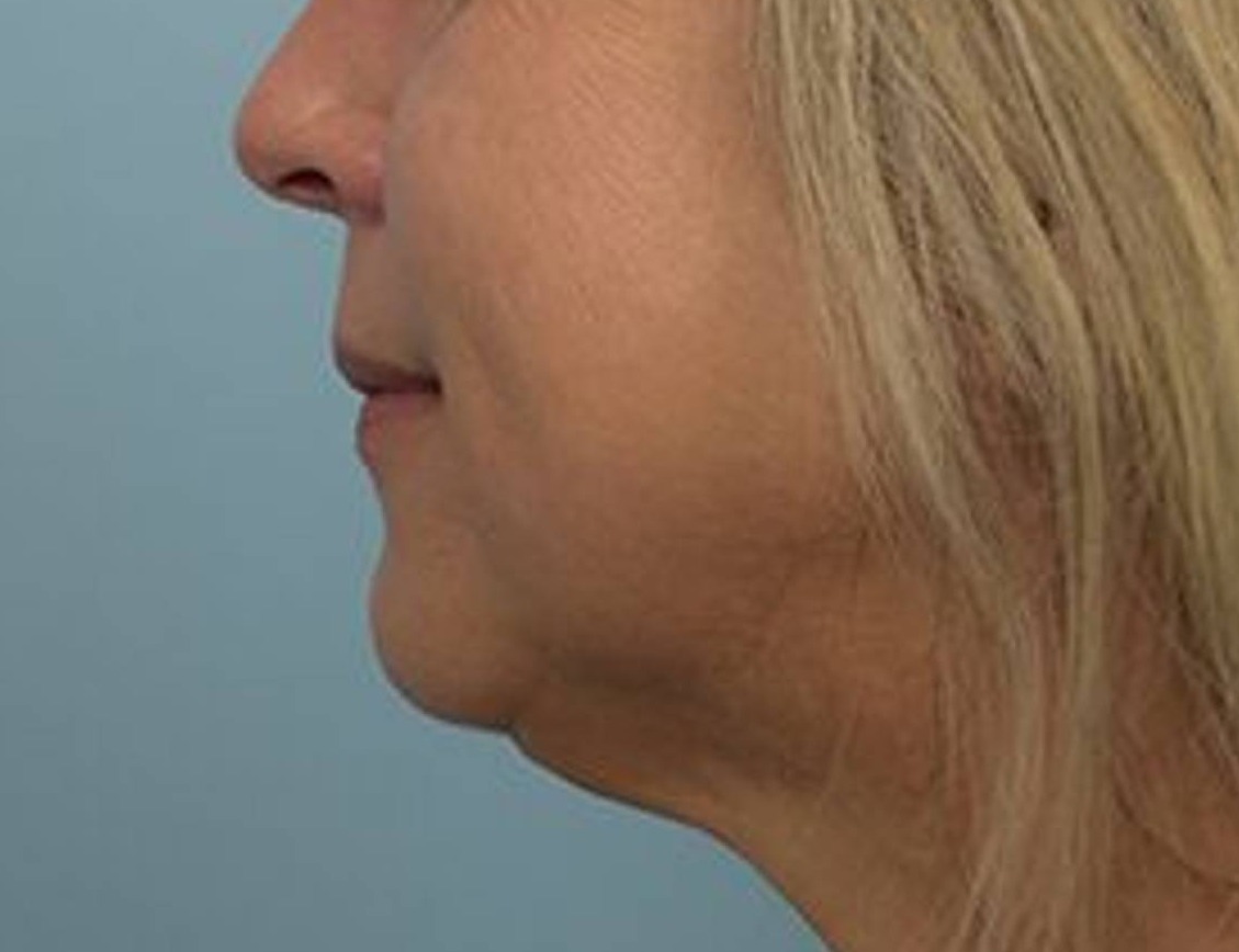 Buccal Fat Removal Before & After Image