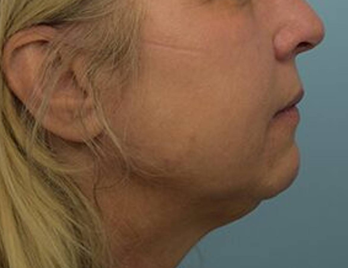 Buccal Fat Removal Before & After Image