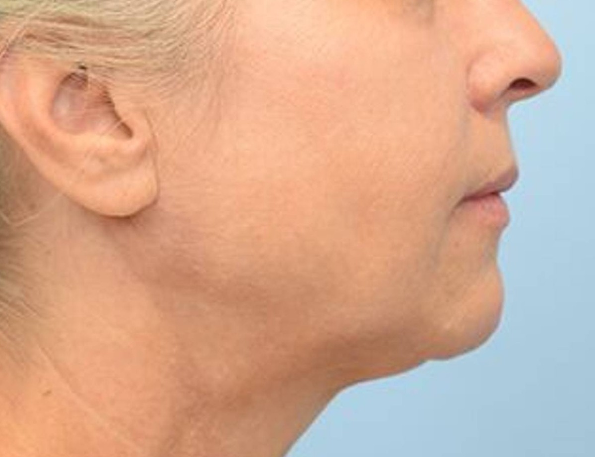 Buccal Fat Removal Before & After Image