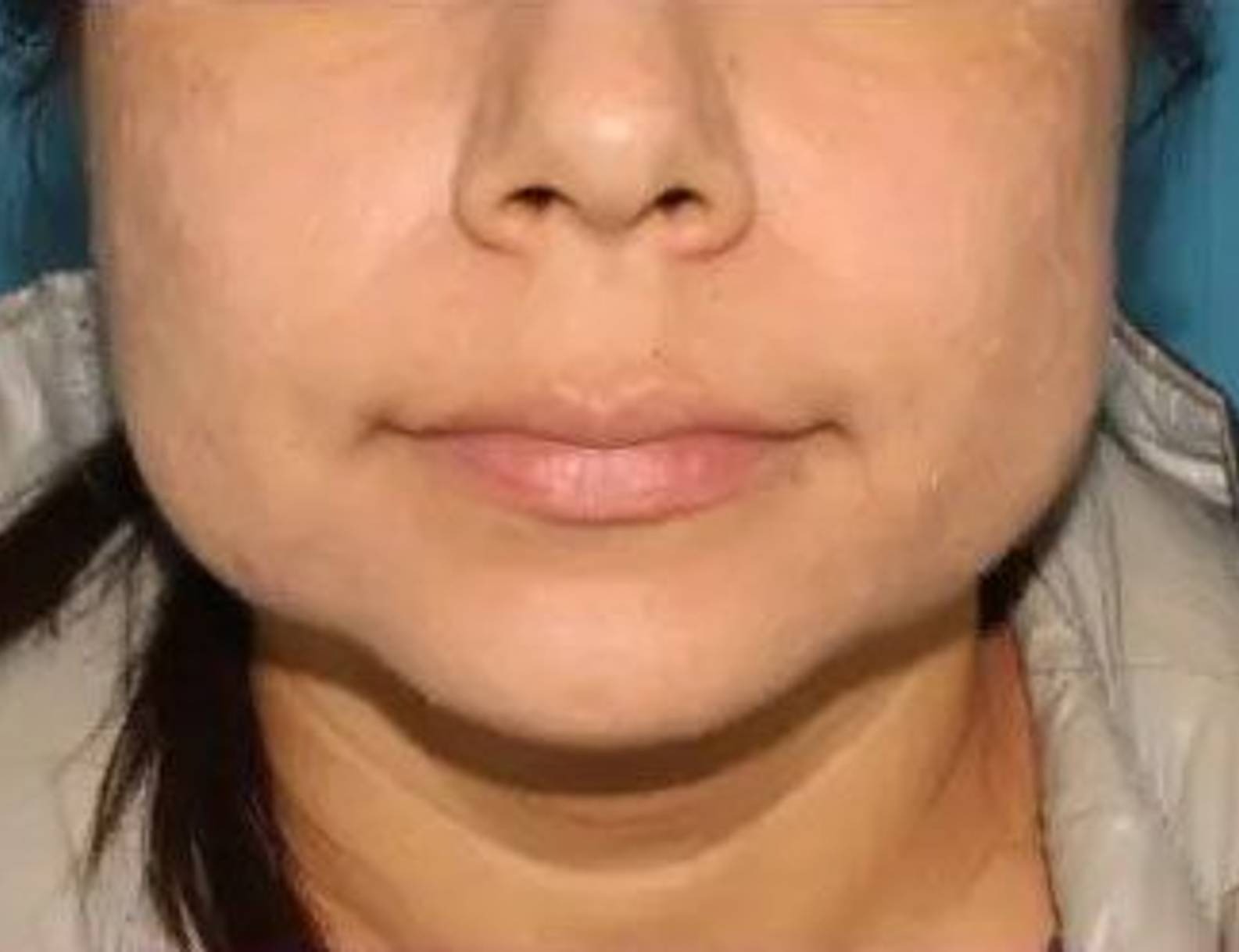 Buccal Fat Removal Before & After Image