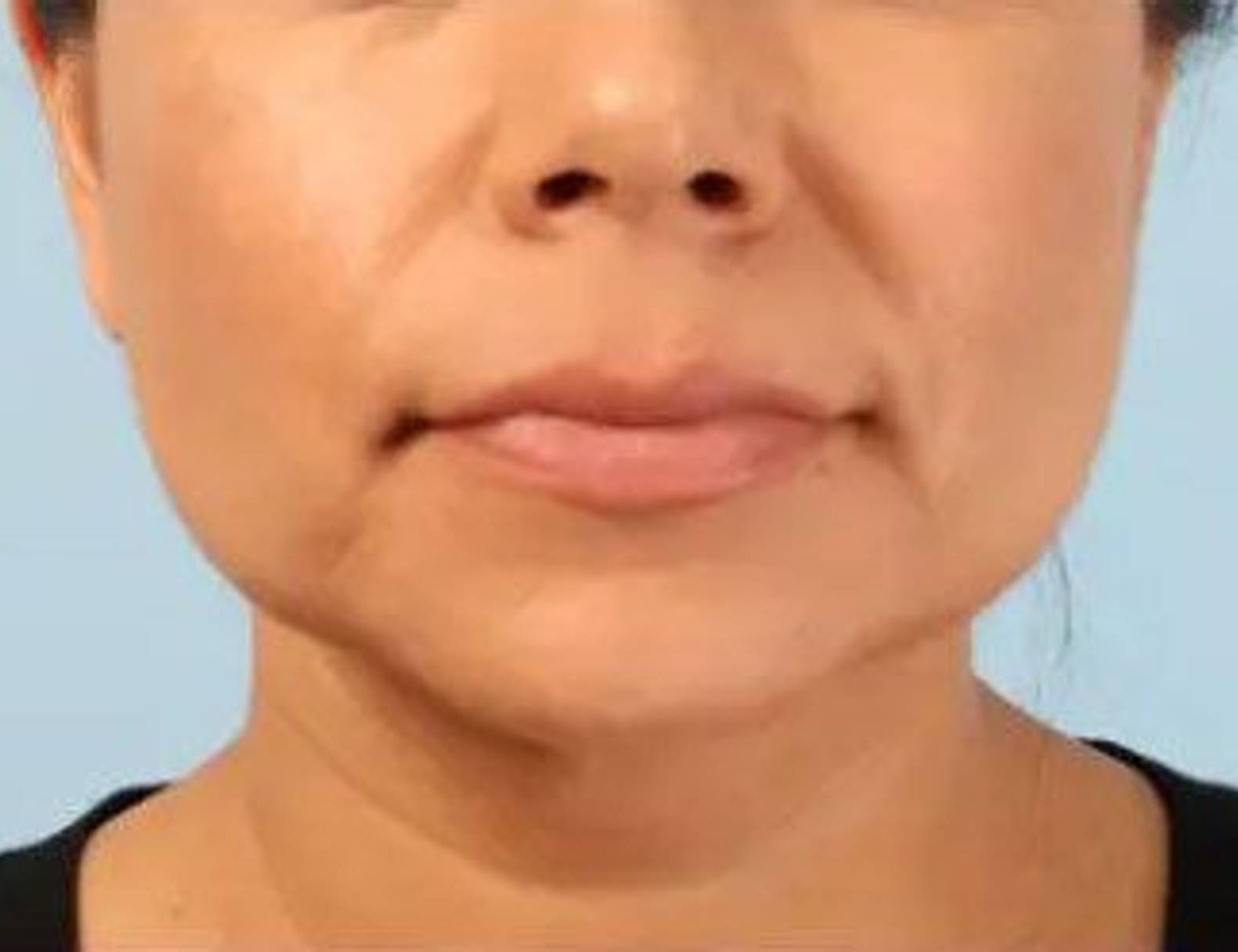 Buccal Fat Removal Before & After Image