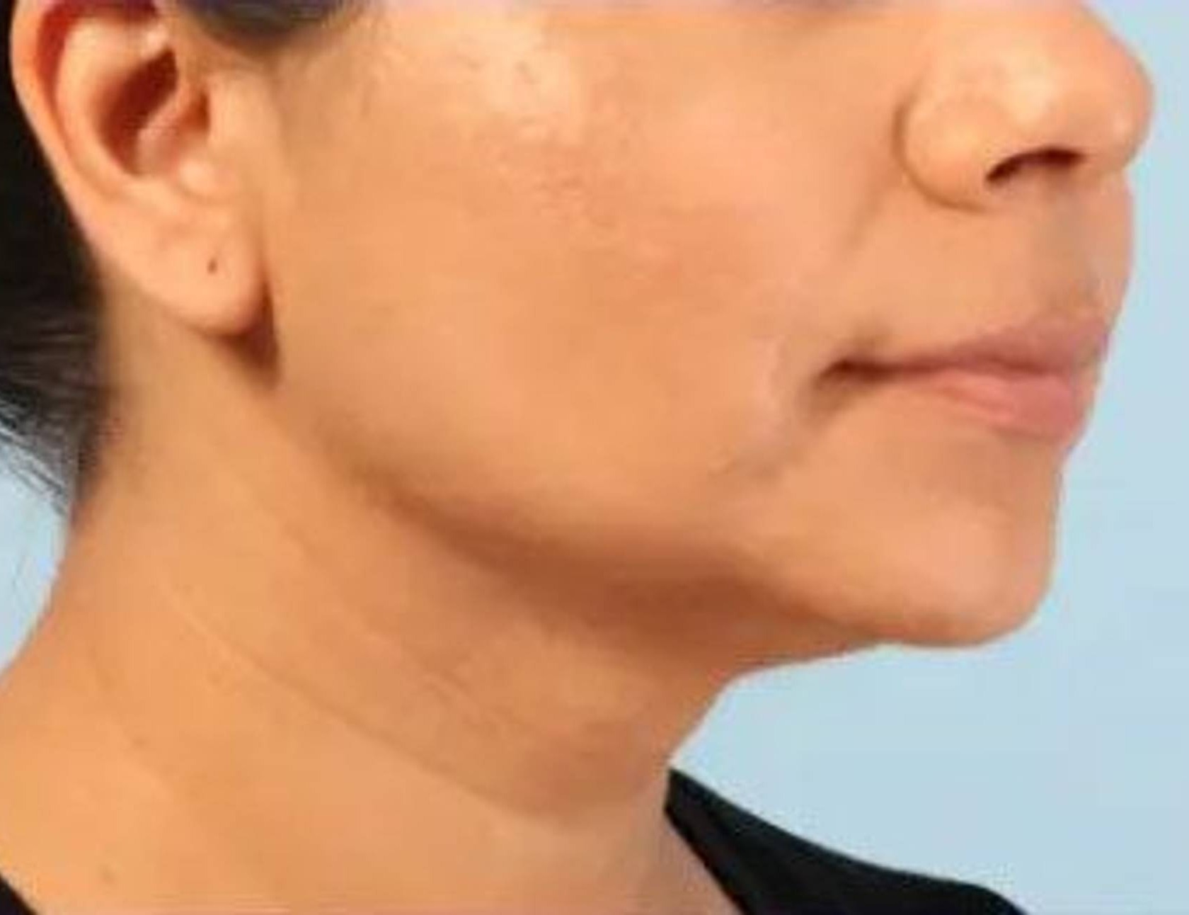 Buccal Fat Removal Before & After Image