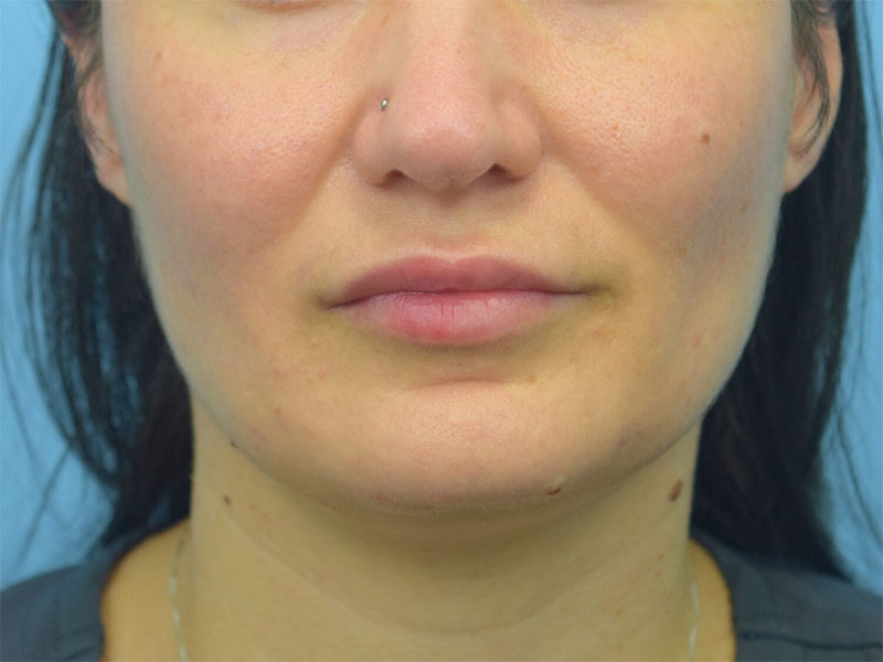 Buccal Fat Removal Before & After Image