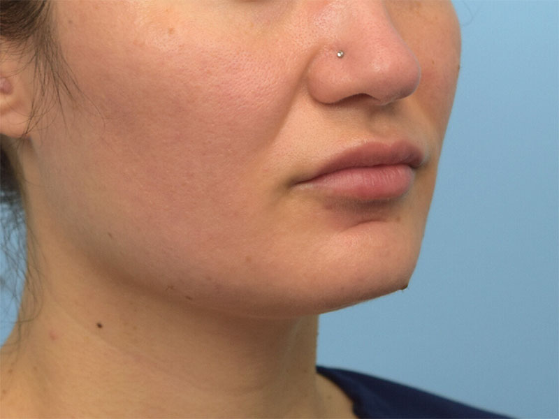 Buccal Fat Removal Before & After Image