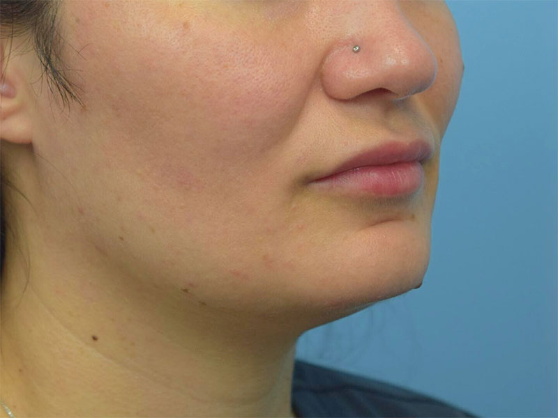 Buccal Fat Removal Before & After Image