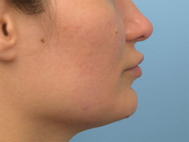 Buccal Fat Removal Before & After Image