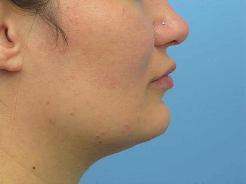 Buccal Fat Removal Before & After Image