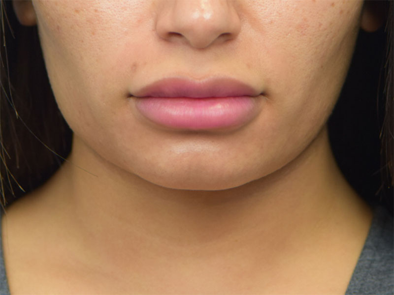 Buccal Fat Removal Before & After Image